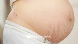 Avoid Stretch Marks During Pregnancy with Proper Hydration