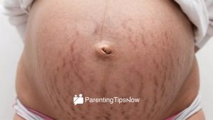 Avoid Stretch Marks During Pregnancy Eating Moderately