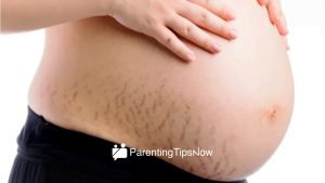 Natural Remedies for Minimizing or to Avoid Stretch Marks During Pregnancy