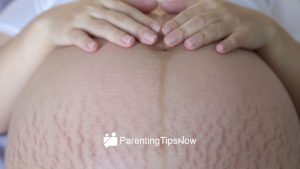 Understanding Causes of Stretch Marks During Pregnancy